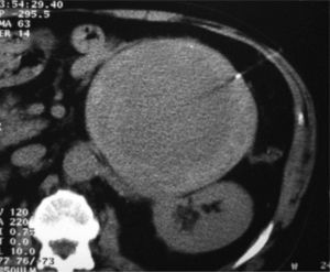 Masa quística en tomografía computarizada abdominal con zonas de realce periférico en fase arterial, indicativa de cistoadenocarcinoma pancreático.