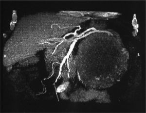 Arteria y vena renales que penetran en el tumor, visualizado mediante angio-tomografía computarizada.
