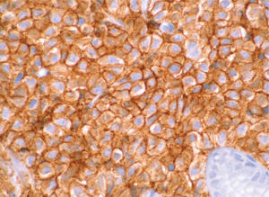 Las células tumorales expresan CD 38 (×400).