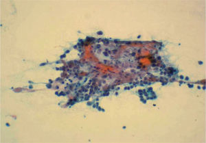 Punción-aspiración con aguja fina ovárica congregados de células epiteliales oncocitarias con tapizamiento endotelial y presencia de bilis (× 120).