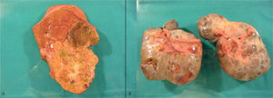 Superficie de corte de la tumoración hepática con cicatriz central, sobre hígado no cirrótico (A) y masa tumoral ovárica bilateral (B).