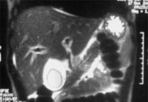 Resonancia magnética hepática. Engrosamiento de la pared vesicular junto con edema periportal periférico.