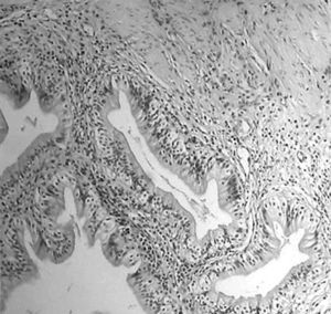 Examen histológico de la vesícula biliar. Abundantes linfocitos intraepiteliales e infiltrados linfocíticos moderados en la lámina propia, con hallazgos sim ilares focales en la submucosa.