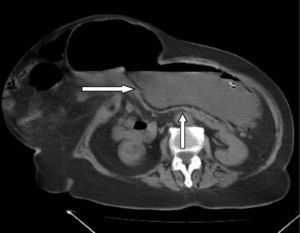 Tomografía computarizada abdominal sin contraste. Neumatosis de las paredes gástricas.