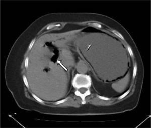 Tomografía computarizada abdominal sin contraste. Gas en el sistema venoso portal.