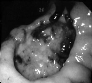 Imagen endoscópica de una úlcera profunda en la incisura angularis.