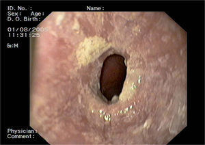 Imagen endoscópica de esófago con placas blanquecinas y estenosis esofágica.