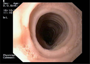 Imagen endoscópica del esófago anillado, tras el tratamiento con corticoides.