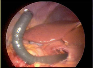 Visión de la cavidad peritoneal a través de un acceso transgástrico.