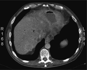 Tomografía computarizada abdominal, en la que se aprecian múltiples abscesos hepáticos bilobares y una colección subfrénica derecha.