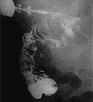 Estudio radiográfico que muestra el paso de contraste directamente al colon a través de la gastrostomía endoscópica percutánea.