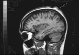Resonancia magnética de cráneo. Lesiones periostóticas parietales en la calota craneal.