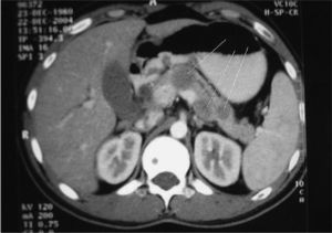 Tomografía computarizada toracoabdominal. Lesión en la cabeza pancreática de 4 × 4 cm, y lesiones en el cuerpo y la cola pancreáticas de 2 cm.