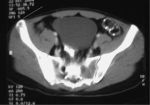 Tomografía computarizada toracoabdominal. Lesiones líticas en el cuerpo vertebral y la espina ilíaca anterosuperior.