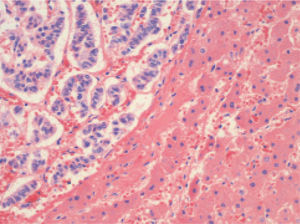M etástasis hepática de tumor endocrino (HE ×200).