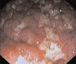 A fectación mucosa difusa con úlceras y sangrado espontáneo (subpuntuación endoscópica 3 en la escala de la Clínica Mayo).