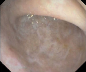 Curación mucosa después de tratamiento con tacrolimus (subpuntuación endoscópica 0).