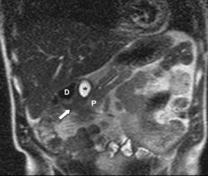 Secuencia HASTE coronal de resonancia magnética. Lesión hipointensa localizada en el surco pancreatoduodenal (flecha), con quiste (*) adyacente. D: duodeno; P: páncreas.