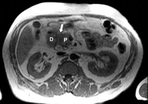 Secuencia T1. Lesión hipointensa en el surco pancreatoduodenal (flecha). D: duodeno; P: páncreas.