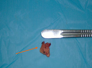 Imagen de la pieza quirúrgica, donde se aprecia la sutura (señalado por la flecha).