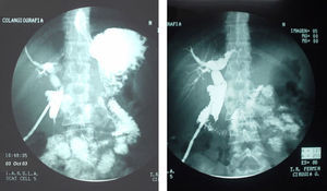 Imágenes de colangiografía intraoperatoria, donde se aprecia una adecuada planificación de la vía biliar sin imagen de defecto.