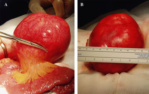 A) Linfangioma quístico originado en el mesenterio. B) Pieza de resección quirúrgica.