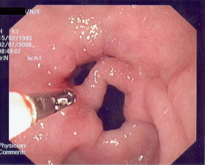 Imagen endoscópica del antro gástrico. Se aprecia un píloro amplio con un tabique de características mucosas normales. Los dos orificios desembocan en el bulbo duodenal.
