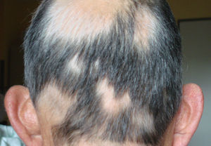 Parches redondeados de pérdida de cabello con pelos en exclamación en los bordes compatible con alopecia areata.