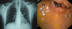 A) Nivel hidroaéreo en cámara gástrica (flechas). B) Úlcera gástrica yuxtapilórica de aspecto endoscópicamente maligno, que retrae y estenosa el píloro.