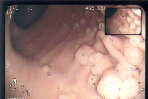 Poliposis gástrica que afecta al cuerpo y el fundus y respeta el antro.