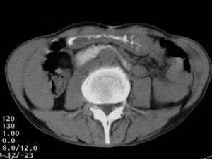 Axial CT images five days later where the phitobezoar is not seen. Stomach relieves its dilatation and the oral contrast progress distally through the vascular compresion.