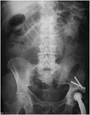 Radiografía simple de abdomen en el momento del ingreso en la que se aprecian asas dilatadas de intestino delgado.