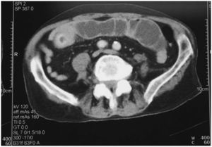 Tomografía computarizada abdominal en la que se observa engrosamiento de la pared intestinal con captación de contraste y una masa intratumoral, de probable origen tumoral.