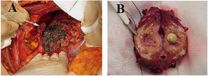 (A) Imagen del lecho de resección hepático y trayecto fistuloso cutáneo del absceso (flecha). (B) Lesión granulomatosa hepática con litiasis central.