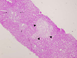 cilindro de biopsia hepática del caso número 1. Tinción de hematoxilina y eosina (×40). Se observa afectación portal (flechas) y central con fenómenos de pericolangitis, endotelitis y de necrosis centrozonal (triángulos).