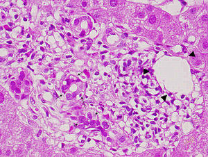 cilindro de biopsia hepática del caso número 1. Tinción de hematoxilina y eosina (×400). Se observa afectación portal que muestra infiltrados inflamatorios portales polimorfos que afectan la pared del ducto (flechas) y de la vena portal (triángulos).