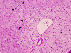 cilindro de biopsia hepática del caso 4. Tinción de hematoxilina y eosina (×200). Se observa afectación portal con afectación en capas de cebolla del conducto biliar (flechas), infiltrado polimorfo que afecta la pared de los ductulillos, que se muestran muy proliferados e invaden las zonas cercanas del lobulillo (triángulos).
