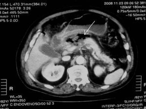 En la región gastropancreática se observa una zona mal definida con aumento de la densidad y con presencia de gas (flecha) compatible con pancreatitis enfisematosa.