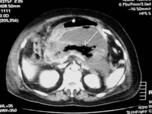 Necrosis de la mayor parte de la glándula pancreática con presencia de gas (flecha) en la celda pancreática.