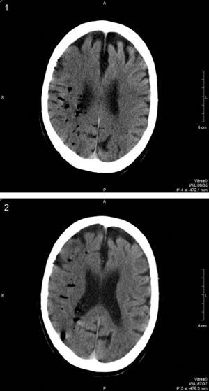 TC cráneal sin contraste realizada 6h después del procedimiento colangioendoscópico y el inicio de la sintomatología. Los cortes tomográficos realizados en ambos centros semiovales muestran la existencia de múltiples imágenes redondeadas de baja densidad compatibles con múltiples burbujas aéreas intraarteriales distribuidas a lo largo del territorio vascular de la arteria cerebral media derecha. Comienzan a observarse los signos precoces típicos de un accidente isquémico agudo con pérdida de la diferenciación corticosubcortical y tenue hipoatenuación del hemisferio cerebral derecho producidas por émbolos gaseosos.