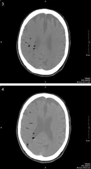Detalle morfológico con “ventana de pulmón” que permite un mayor resalte de las burbujas con el parénquima cerebral dispuestas a lo largo del trayecto de la arteria cerebral media derecha.
