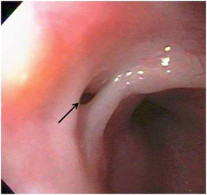 Visión endoscópica de fístula traqueoesofágica (flecha).