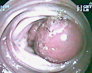 Colonoscopia: masa ovalada en el ángulo hepático que ocupa casi toda la luz del colon.