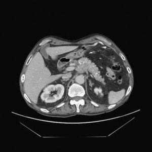 Imagen de TC que muestra masa de cuerpo de páncreas de 3×2cm que engloba al tronco celíaco.