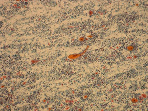 Estudio citológico donde sobre un fondo con intensa diátesis tumoral se observan abundantes células escamosas con marcada atipia, núcleos pleomórficos y citoplasmas orangófilos.