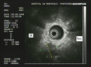 Ultrasonografía endoscópica que identifica masa dependiente de segmentos posterosuperiores del cuerpo pancreático sin claro plano de clivaje con la pared gástrica e íntima relación con las arterias hepática y esplénica.
