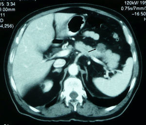Tomografía computarizada (TC) 1. TC de abdomen (paciente n.o 2): se observa metástasis periférica en cuerpo pancreático (flecha).