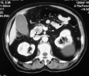 Tomografía computarizada (TC) 2. TC de abdomen (paciente n.o 2): se observa metástasis intrapancreática (flecha).