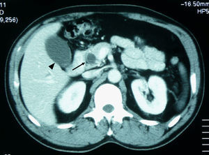 Tomografía computarizada (TC) 3. TC de abdomen (paciente n.o 3): se observa vesícula distendida (cabeza de flecha) y metástasis intrapancreática (flecha).