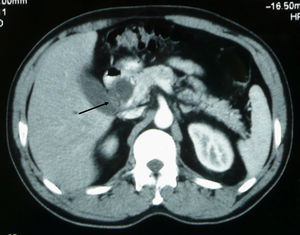 Tomografía computarizada (TC) 4. TC de abdomen (paciente n.o 3): se observa obstrucción y aumento de tamaño del proceso uncinado (flecha).